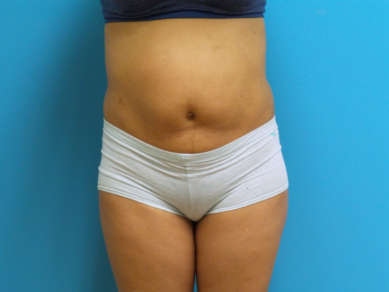 Tummy Tuck Before and After Pictures Fort Lauderdale, FL