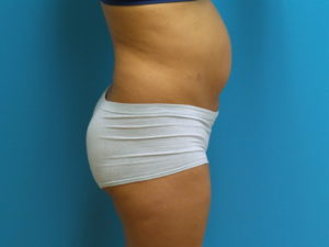 Tummy Tuck Before and After Pictures Fort Lauderdale, FL