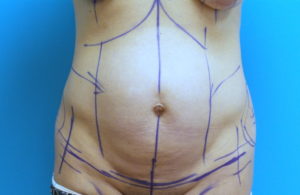 Tummy Tuck Before and After Pictures Fort Lauderdale, FL