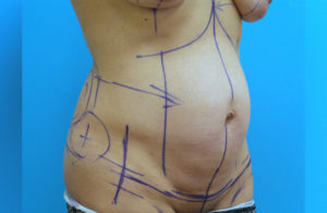 Tummy Tuck Before and After Pictures Fort Lauderdale, FL