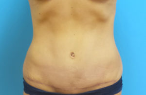 Tummy Tuck Before and After Pictures Fort Lauderdale, FL