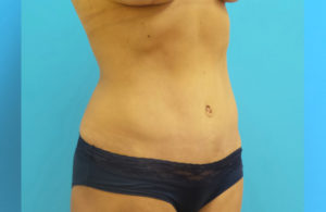 Tummy Tuck Before and After Pictures Fort Lauderdale, FL