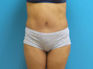 Tummy Tuck Before and After Pictures Fort Lauderdale, FL