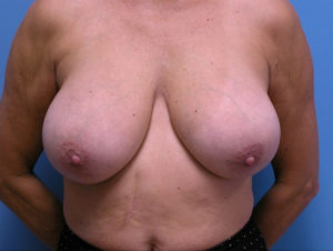 Breast Implant Removal Before and After Pictures Fort Lauderdale, FL