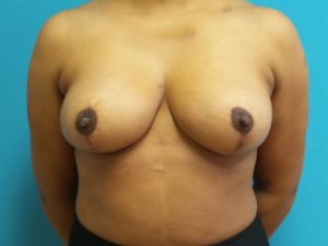 Breast Reduction Before and After Pictures Fort Lauderdale, FL