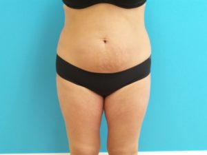 Liposuction Before and After Pictures Fort Lauderdale, FL