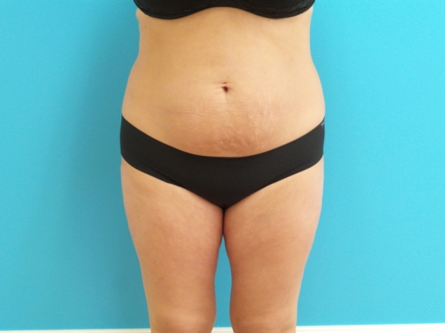 09_05_2018 21_06_00 (3) Liposuction Before and After Pictures Fort Lauderdale, FL