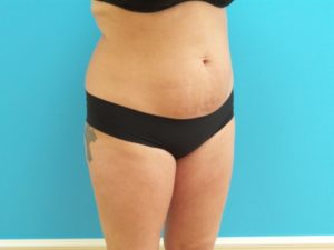 Liposuction Before and After Pictures Fort Lauderdale, FL