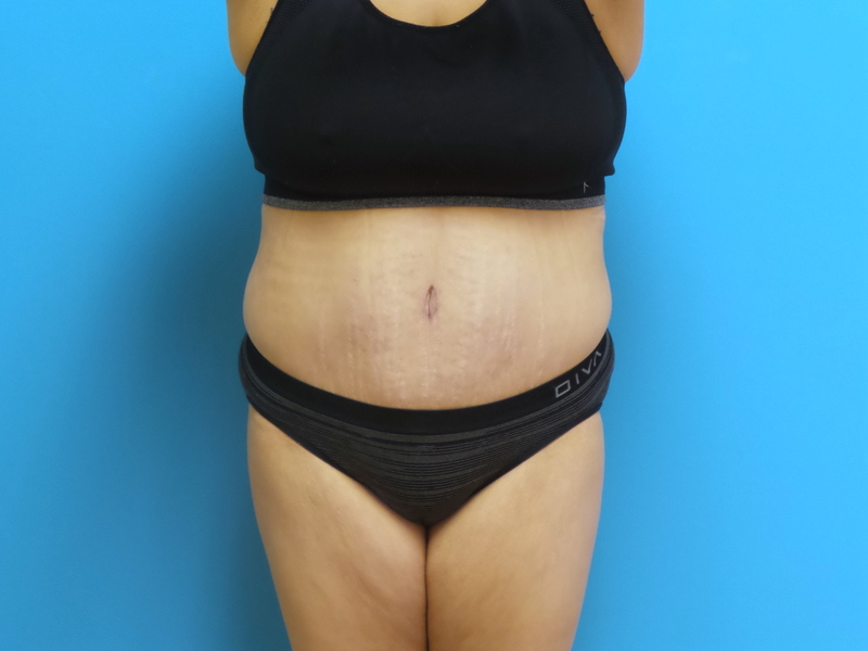 Tummy Tuck Before and After Pictures Fort Lauderdale, FL