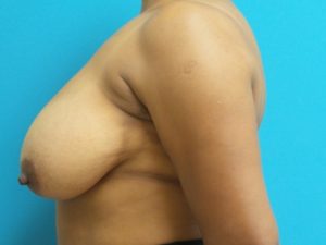 Breast Reduction Before and After Pictures Fort Lauderdale, FL