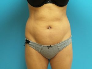 Liposuction Before and After Pictures Fort Lauderdale, FL