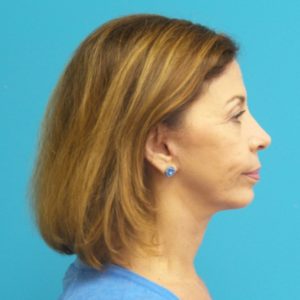 Facelift Before and After Pictures Fort Lauderdale, FL