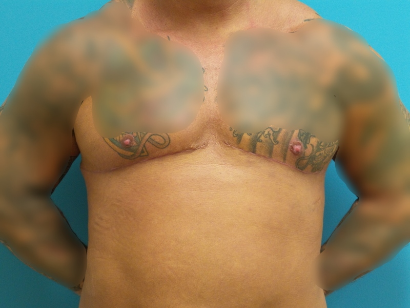 Gynecomastia Before and After Pictures Fort Lauderdale, FL