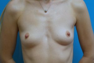 Breast Augmentation Before and After Pictures Fort Lauderdale, FL