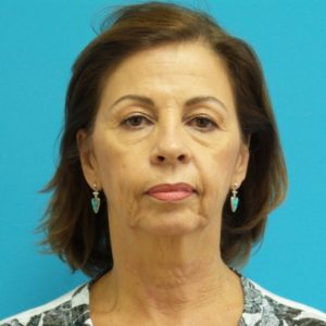 Facelift Before and After Pictures Fort Lauderdale, FL