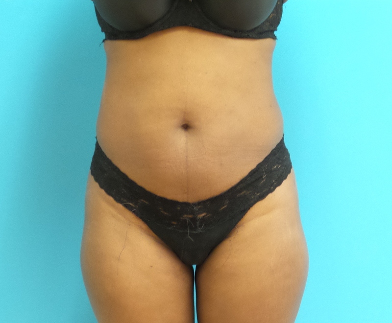 Liposuction Before and After Pictures Fort Lauderdale, FL