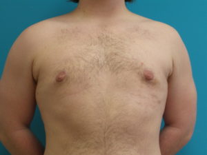 Gynecomastia Before and After Pictures Fort Lauderdale, FL