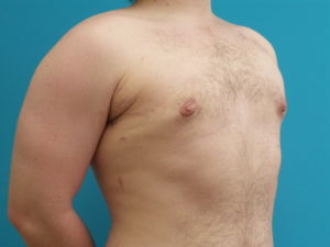 Gynecomastia Before and After Pictures Fort Lauderdale, FL