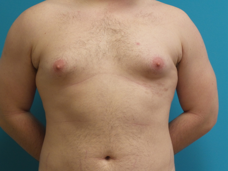 Gynecomastia Before and After Pictures Fort Lauderdale, FL