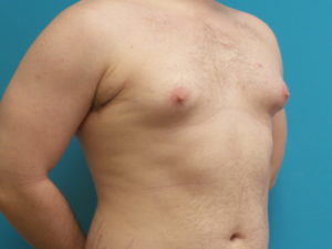 Gynecomastia Before and After Pictures Fort Lauderdale, FL