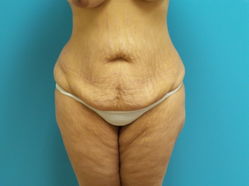 TummyTuck-pt34-front-before Tummy Tuck Before and After Pictures Fort Lauderdale, FL