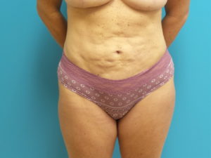 Tummy Tuck Before and After Pictures Fort Lauderdale, FL