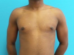 Gynecomastia Before and After Pictures Fort Lauderdale, FL