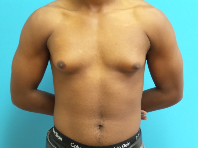 Gynecomastia Before and After Pictures Fort Lauderdale, FL