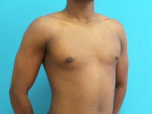 Gynecomastia Before and After Pictures Fort Lauderdale, FL