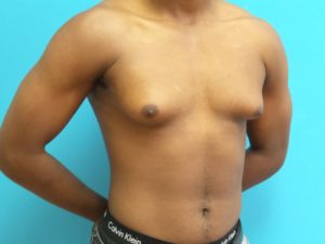 Gynecomastia Before and After Pictures Fort Lauderdale, FL