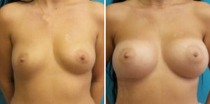 Breast Augmentation Before and After Pictures Fort Lauderdale, FL