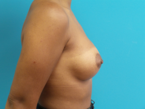 Breast Augmentation Before aand After Pictures Fort Lauderdale, FL