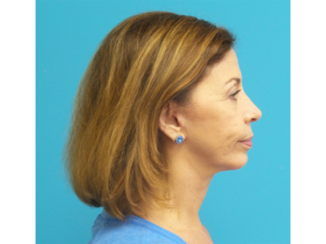 Chin Augmentation Before and After Pictures Fort Lauderdale, FL