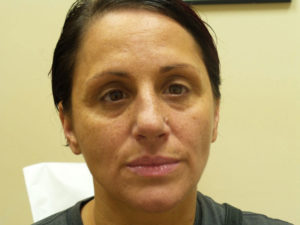 Botox/Dysport Before and After Pictures Fort Lauderdale, FL