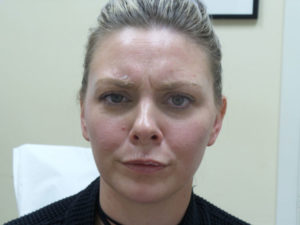 Botox/Dysport Before and After Pictures Fort Lauderdale, FL