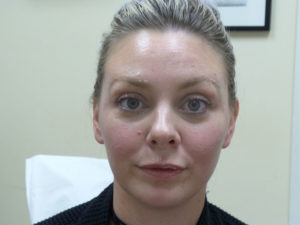 Botox/Dysport Before and After Pictures Fort Lauderdale, FL