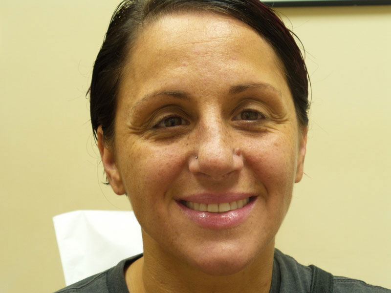 combi-inj-case1-frontalsmile-before Combination Injectable Treatments Before and After Pictures Fort Lauderdale, FL