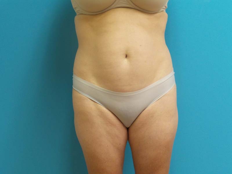 Liposuction Before and After Pictures Fort Lauderdale, FL