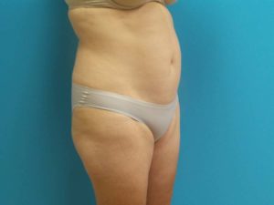 Liposuction Before and After Pictures Fort Lauderdale, FL