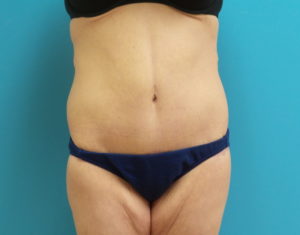 After Massive Weight Loss Before and After Pictures Fort Lauderdale, FL