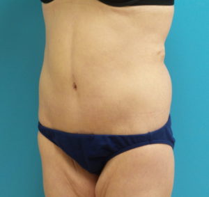 After Massive Weight Loss Before and After Pictures Fort Lauderdale, FL