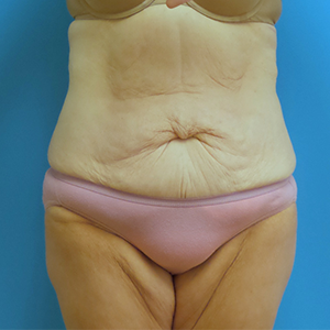 After Massive Weight Loss Before and After Pictures Fort Lauderdale, FL