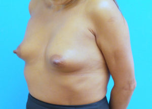 Breast Augmentation Before and After Pictures Fort Lauderdale, FL