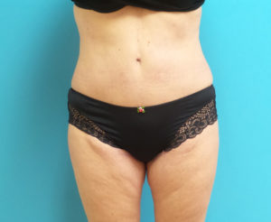 Thigh Lift Before and After Pictures Fort Lauderdale, FL
