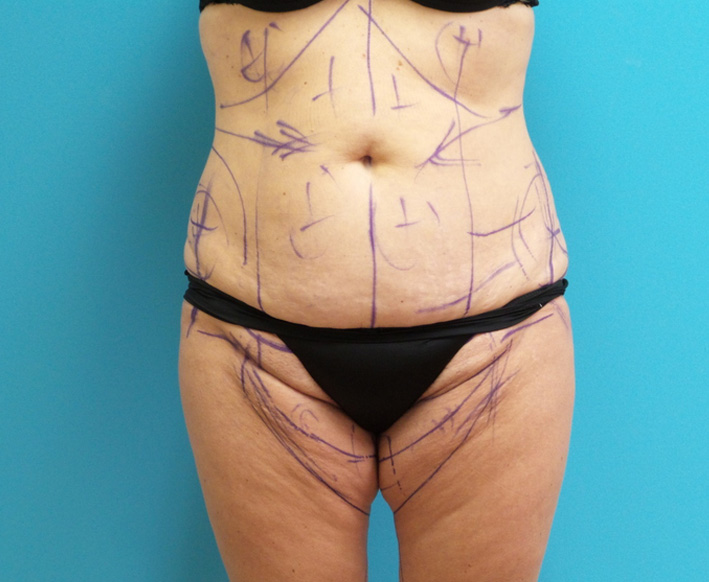 Thigh Lift Before and After Pictures Fort Lauderdale, FL