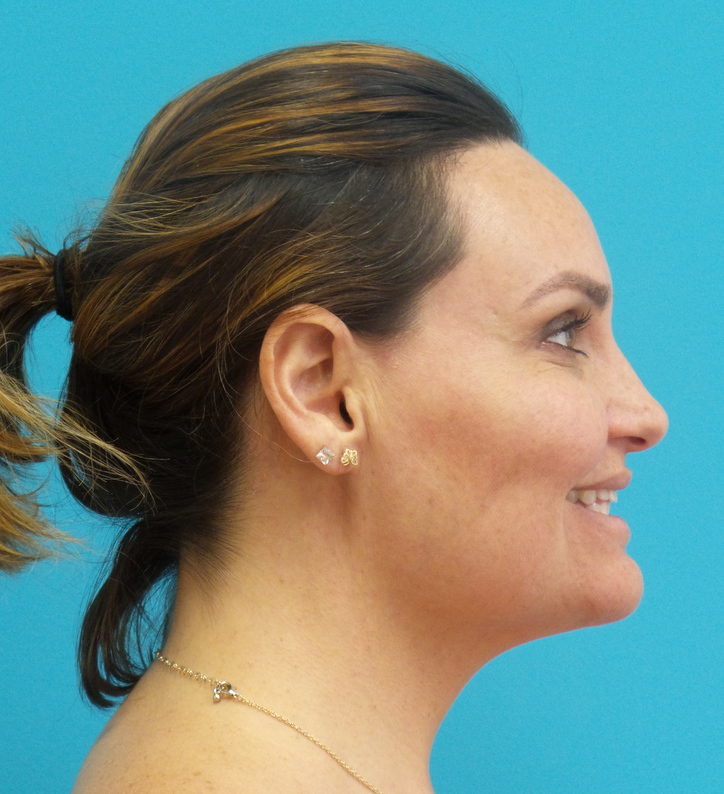 Neck Liposuction Before and After Pictures Fort Lauderdale, FL