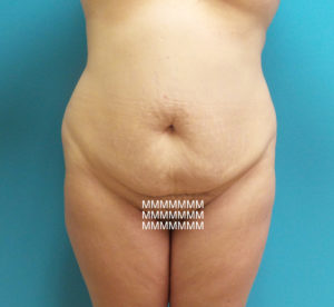 Tummy Tuck Before and After Pictures Fort Lauderdale, FL