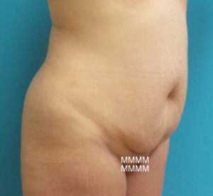 Tummy Tuck Before and After Pictures Fort Lauderdale, FL