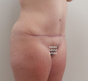 Tummy Tuck Before and After Pictures Fort Lauderdale, FL