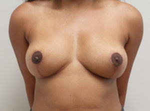 Breast Lift Before and After Pictures Fort Lauderdale, FL